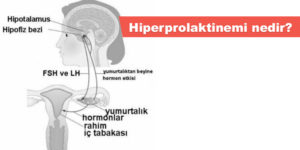 Hiperprolaktinemi nedir?